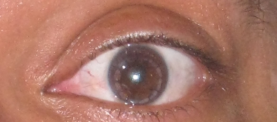 Eye Photos